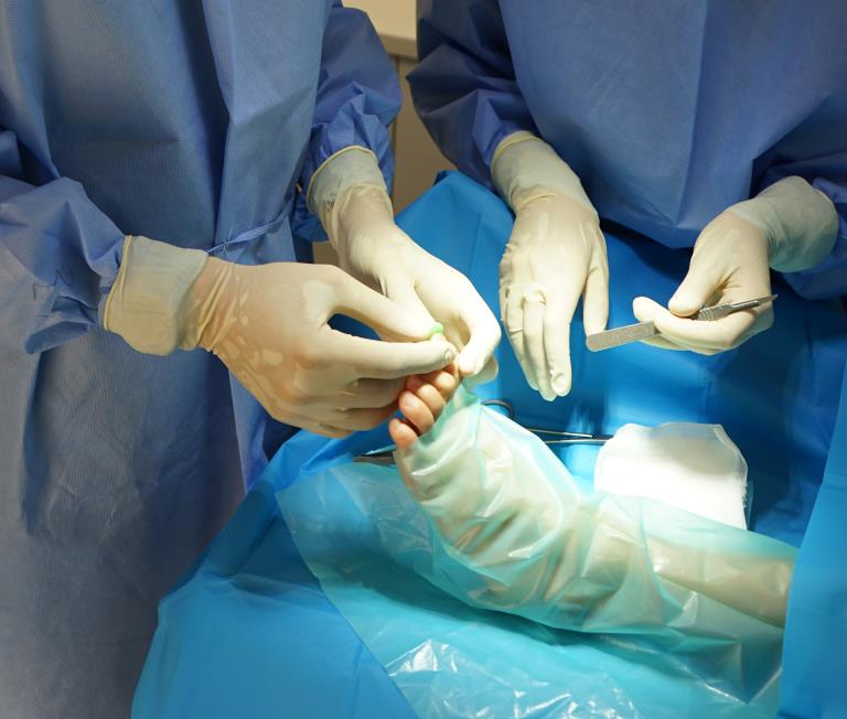 Causas de la uña encarnada